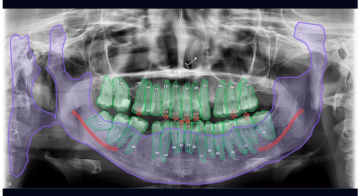 Imagem panorâmica odontológica demonstrativa com marcações de apoio por inteligência artificial